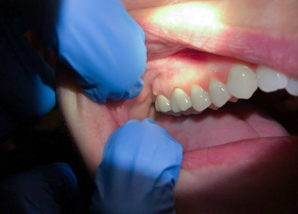 Best Emergency Treatment for Dental Infections or Abscesses in Marion, TX